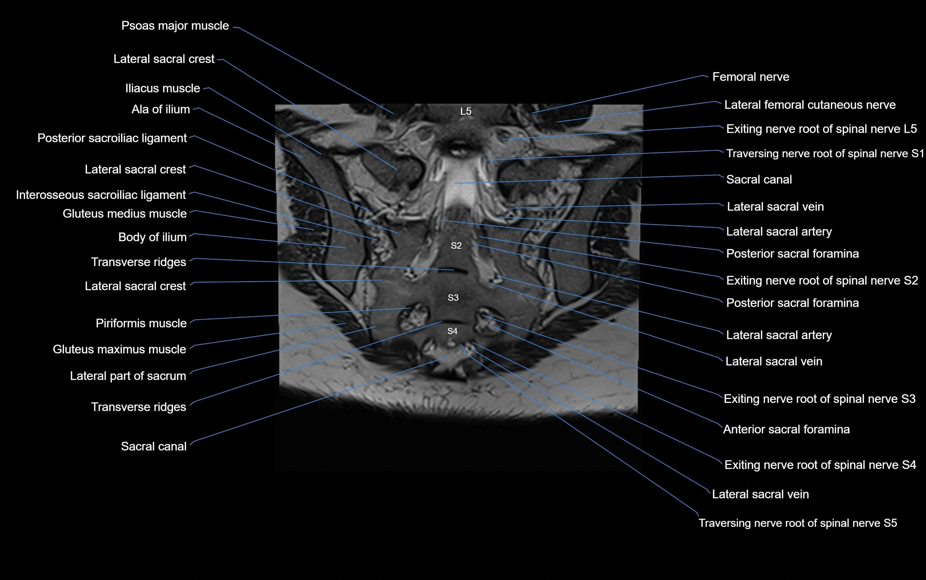 MRI sacroiliac joint coronal cross sectional anatomy  radiology  image-img-00001-00022.webp